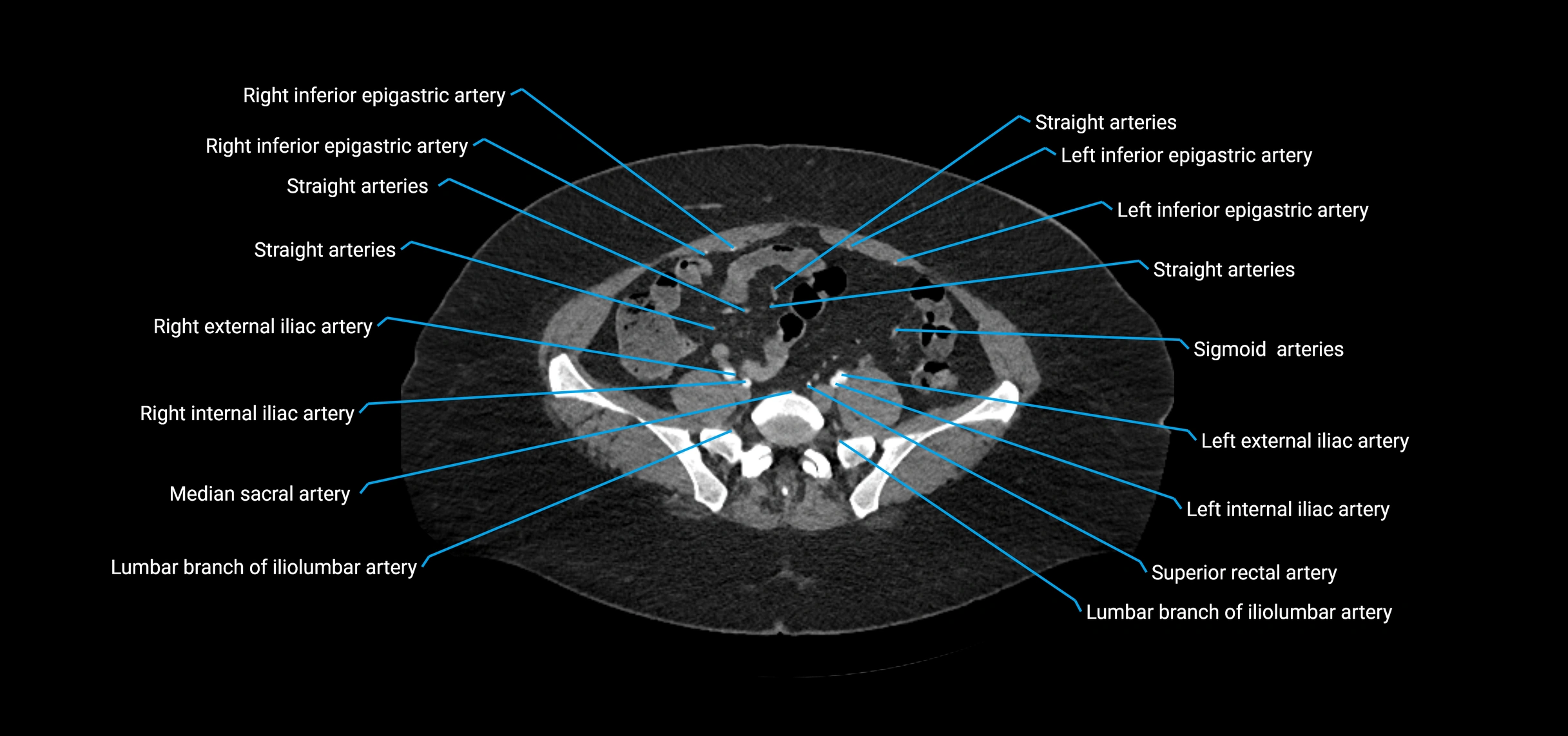 CTA abdomen axial cross sectional anatomy labelled image_174 (2).webp